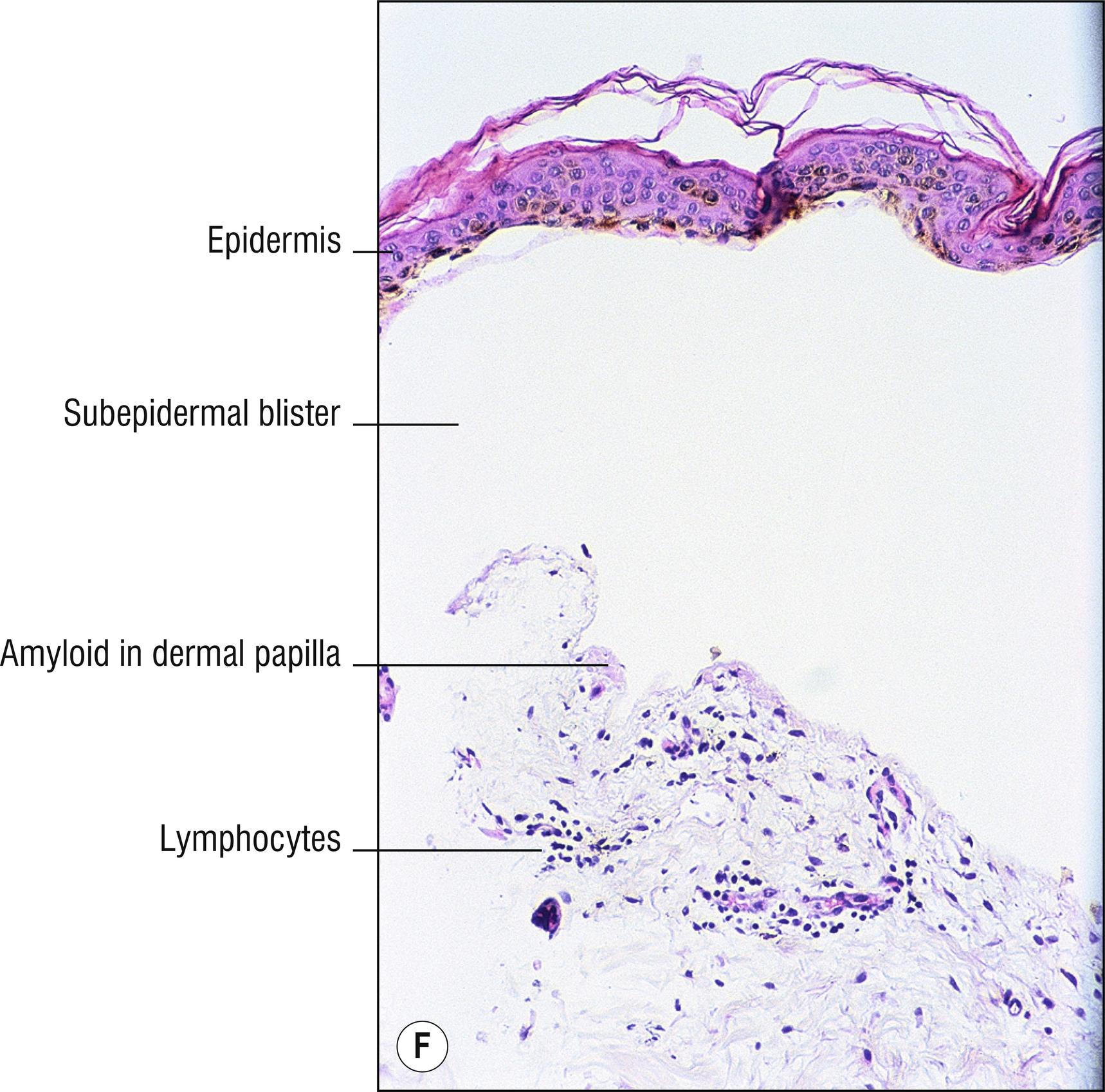 Fig. 8.4, F Bullous amyloidosis (low mag.).