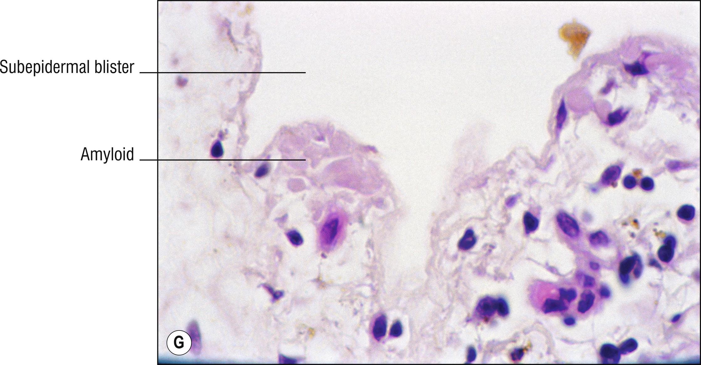 Fig. 8.4, G Bullous amyloidosis (high mag.).