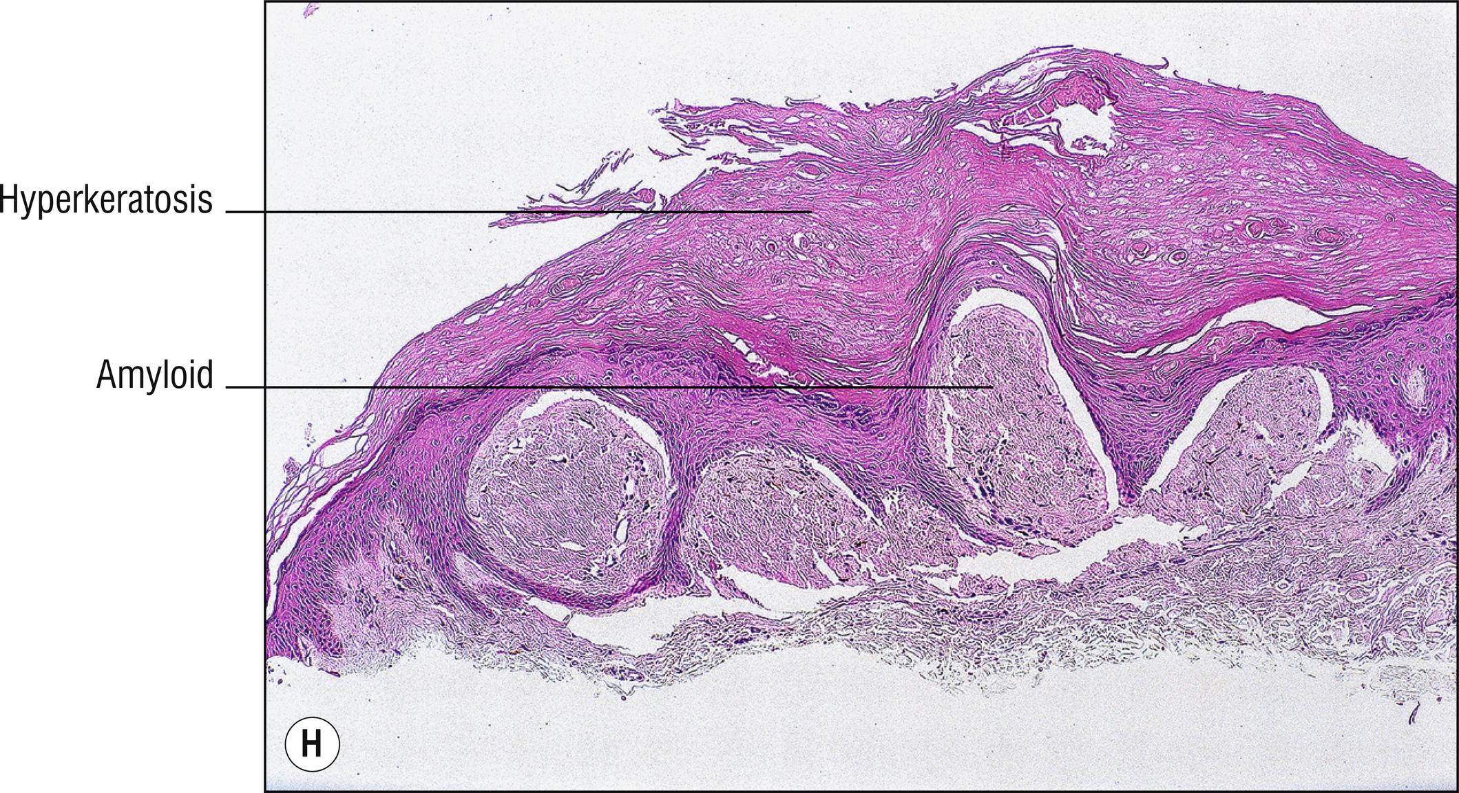 Fig. 8.4, H Lichen amyloidosis.