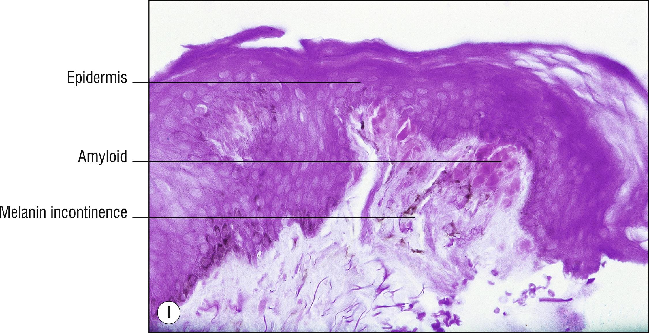 Fig. 8.4, I Macular amyloidosis (crystal violet stain).