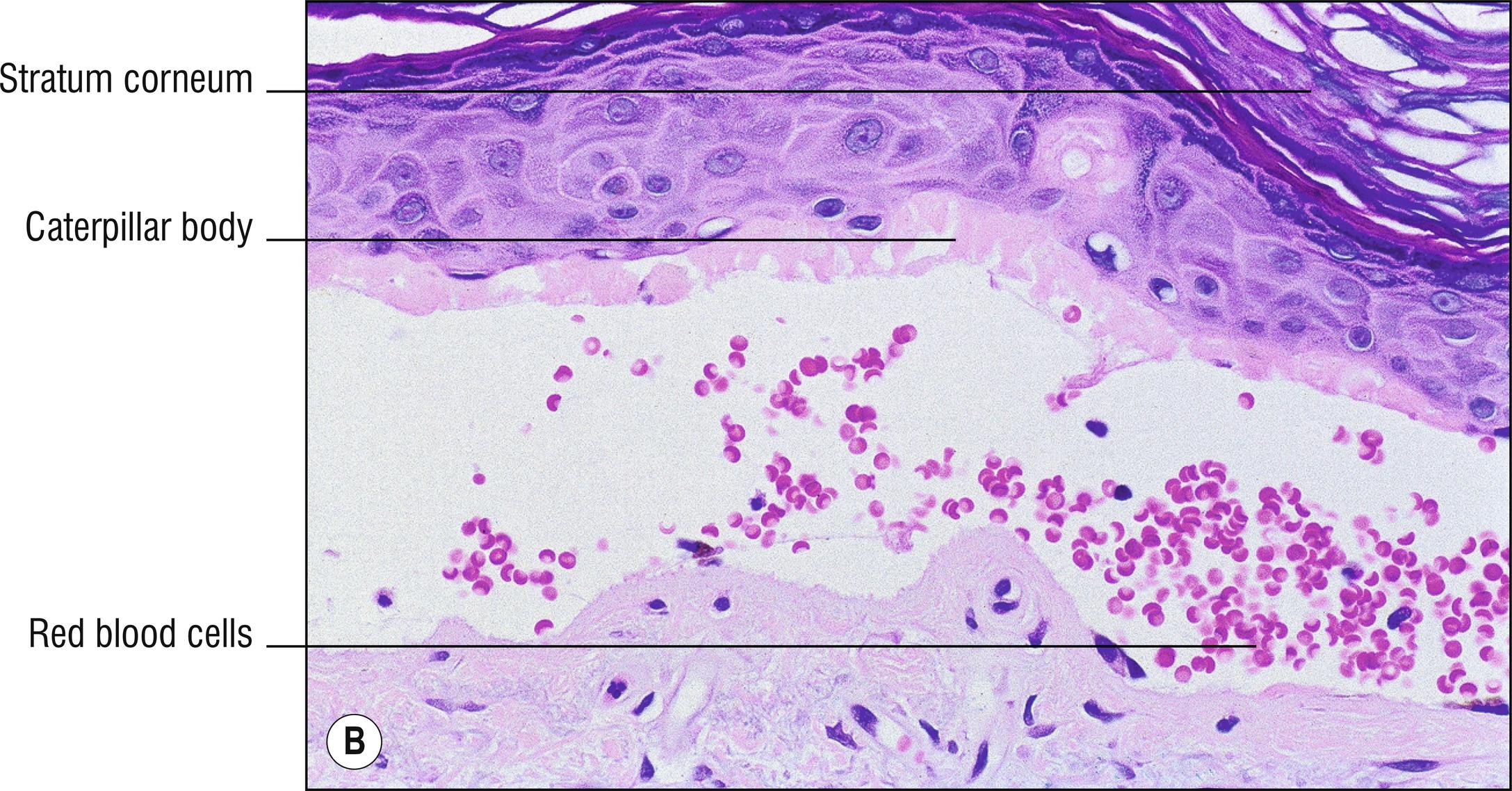 Fig. 8.1, B Porphyria cutanea tarda (medium mag.).