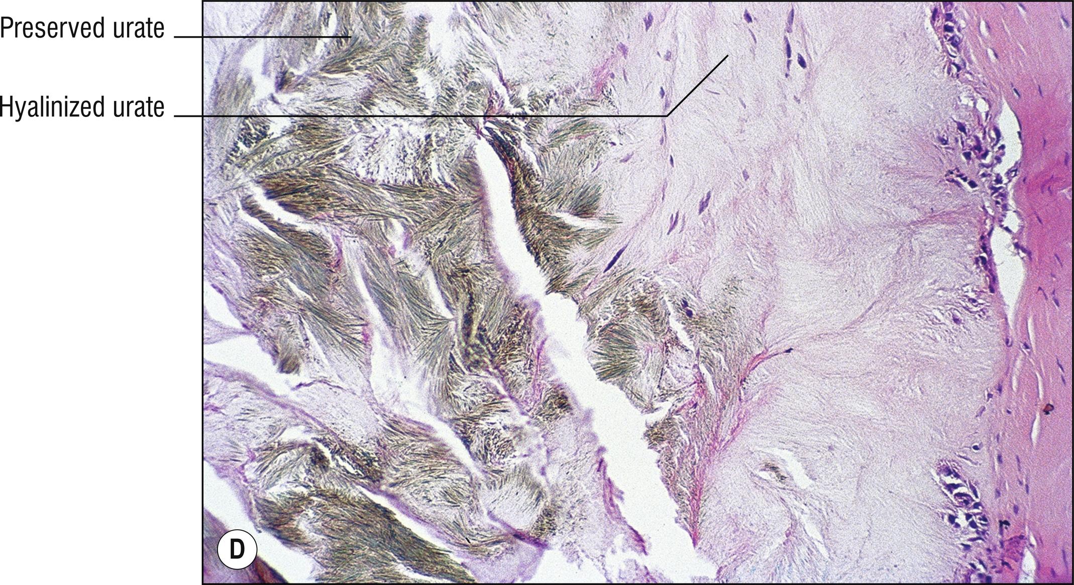 Fig. 8.5, D Gout (alcohol fixed).