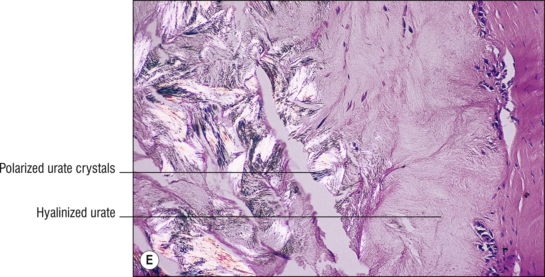 Fig. 8.5, E Gout (alcohol fixed, polarized).