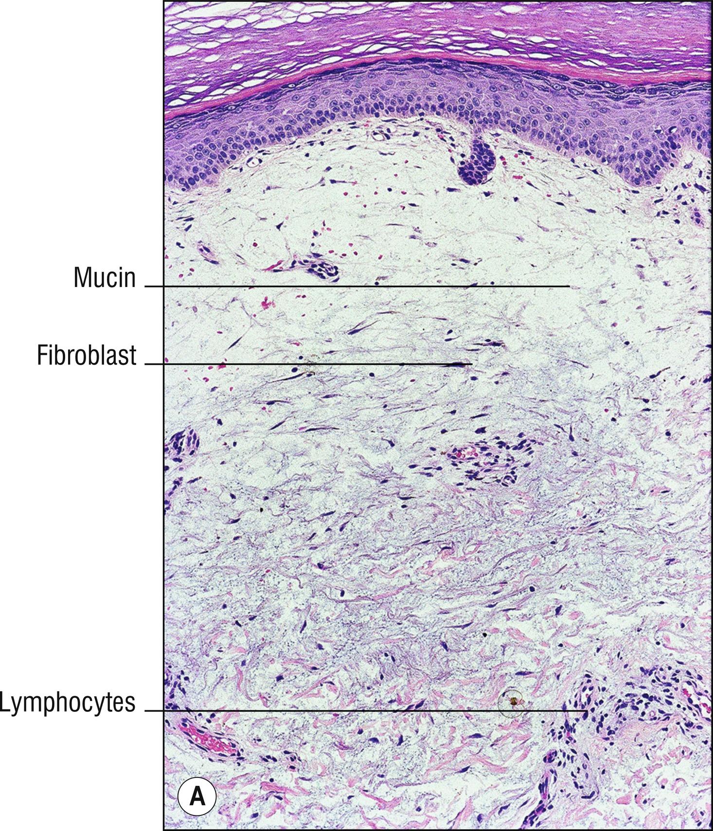 Fig. 8.7, A Pretibial myxedema.