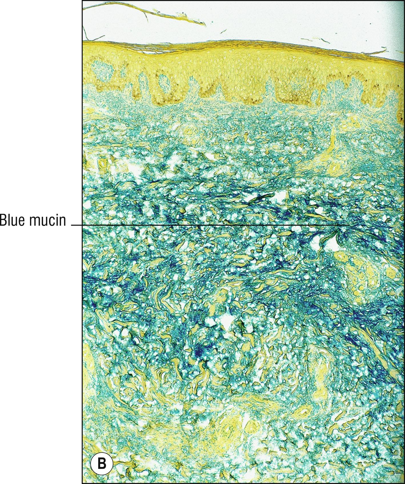 Fig. 8.7, B Pretibial myxedema (colloidal iron stain for mucin).