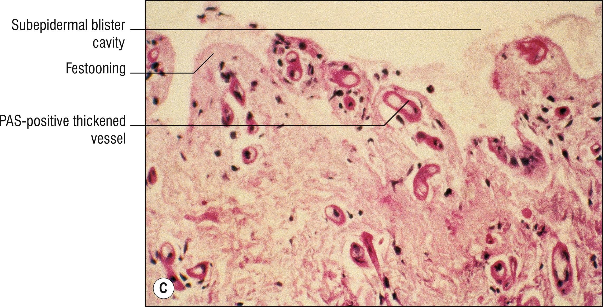 Fig. 8.1, C Porphyria cutanea tarda (PAS stain).