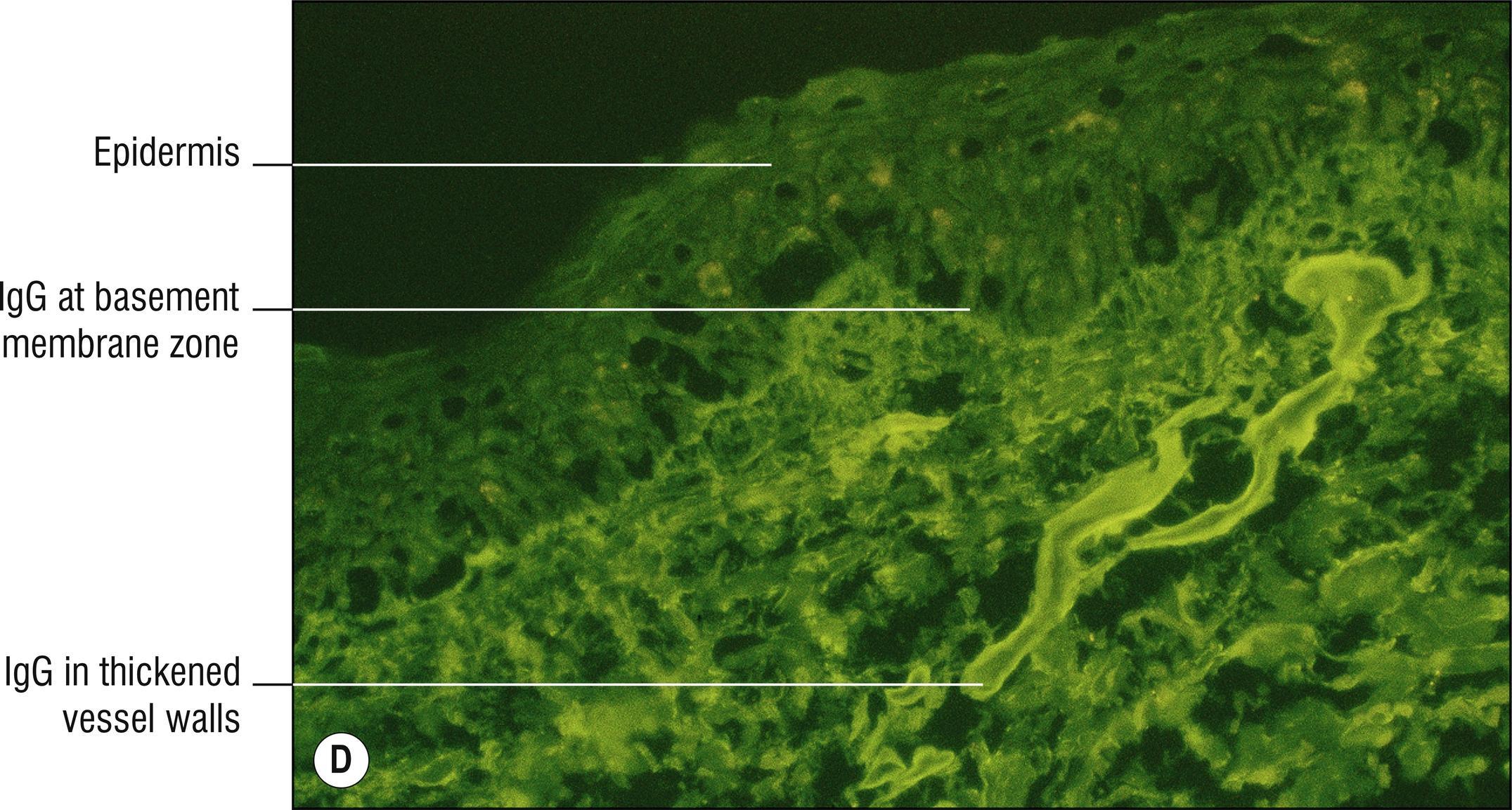 Fig. 8.1, D Porphyria cutanea tarda (IgG immunofluorescence, with prominent perivascular staining and weaker basement membrane linear staining).