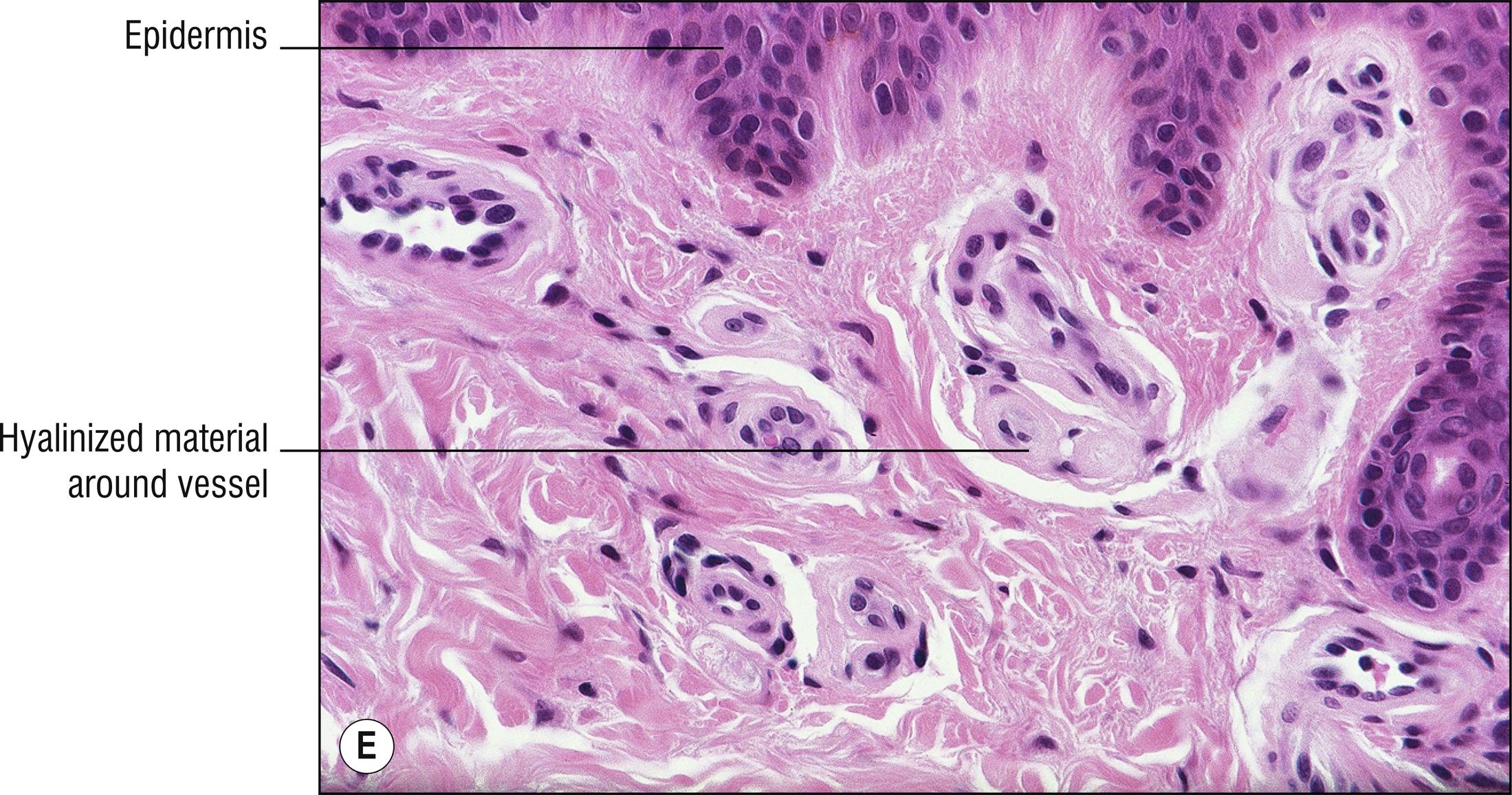 Fig. 8.1, E Erythropoietic protoporphyria.