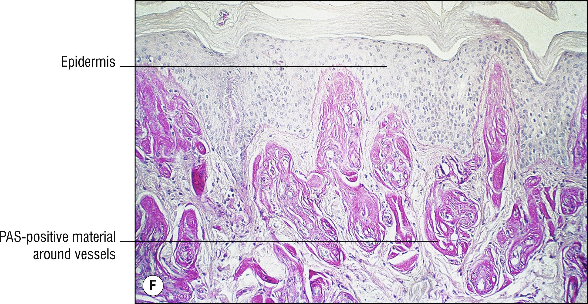 Fig. 8.1, F Erythropoietic protoporphyria (PAS stain).