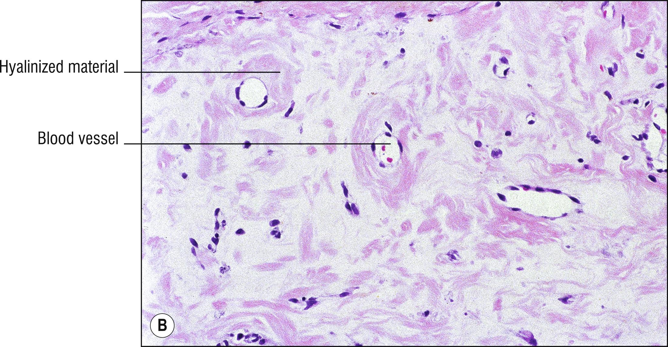 Fig. 8.3, B Juvenile hyaline fibromatosis.