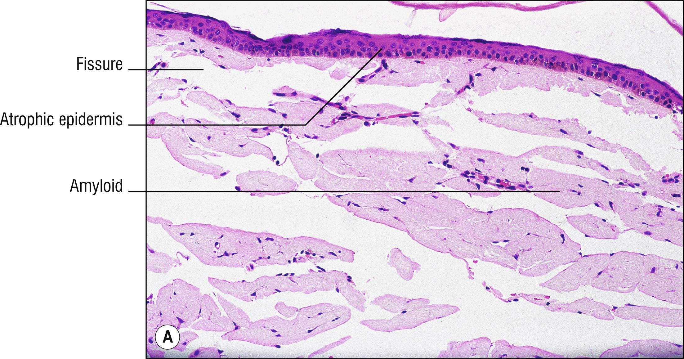 Fig. 8.4, A Primary systemic amyloidosis, eyelid, in patient with myeloma.