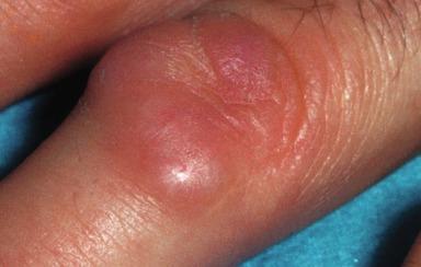 Figure 18.3, Subcutaneous granuloma annulare.