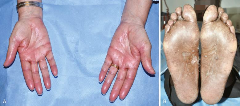 FIGURE 18-1, A, Grade 2 hand-foot syndrome affecting the palms and soles (not shown) in a 62-year-old woman being treated with capecitabine for metastatic breast cancer. The patient also reported pain, burning, tingling sensations, and tightness of skin. B, Grade 2 hand-foot syndrome affecting the palms (not shown) and soles in a 74-year-old man, during treatment with capecitabine for metastatic pancreatic cancer. Note the peeling of skin and hyperkeratotic areas.