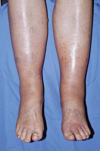 FIGURE 18-2, Grade 2 leg edema in a 73-year-old woman, 1 month into treatment with gemcitabine and Abraxane ® for unresectable pancreatic cancer. Note the erythema, edema, and peeling of skin (“pseudocellulitis”).