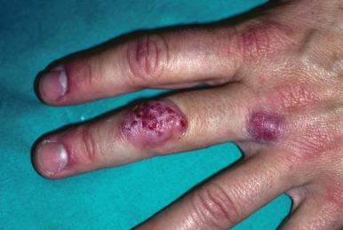 Fig. 22.15, Mycobacterium marinum .