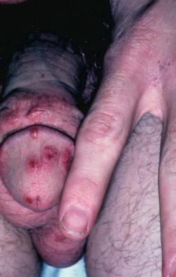 Fig. 22.16, Scabies affecting the penis, scrotum, and interdigital web space.
