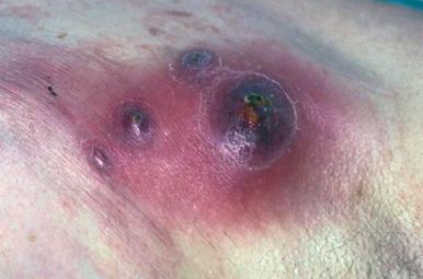 Fig. 22.2, Multiple furuncles coalescing to form a carbuncle.