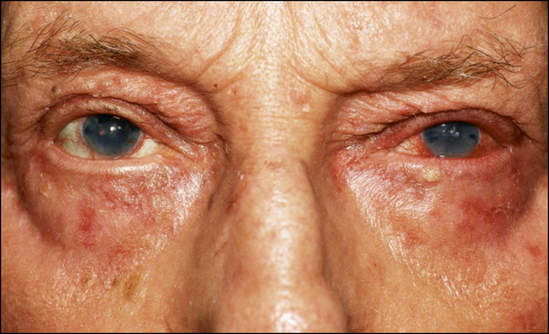 Fig. 64.1, Psoriasis: skin and eyelid involvement.