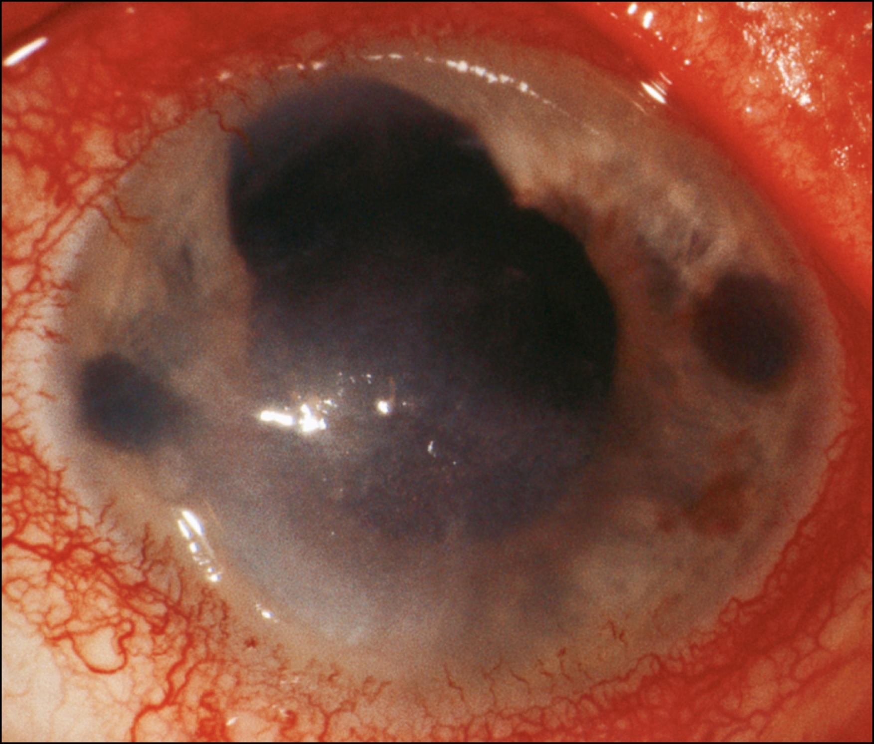 Fig. 64.2, Psoriasis: corneal scar.
