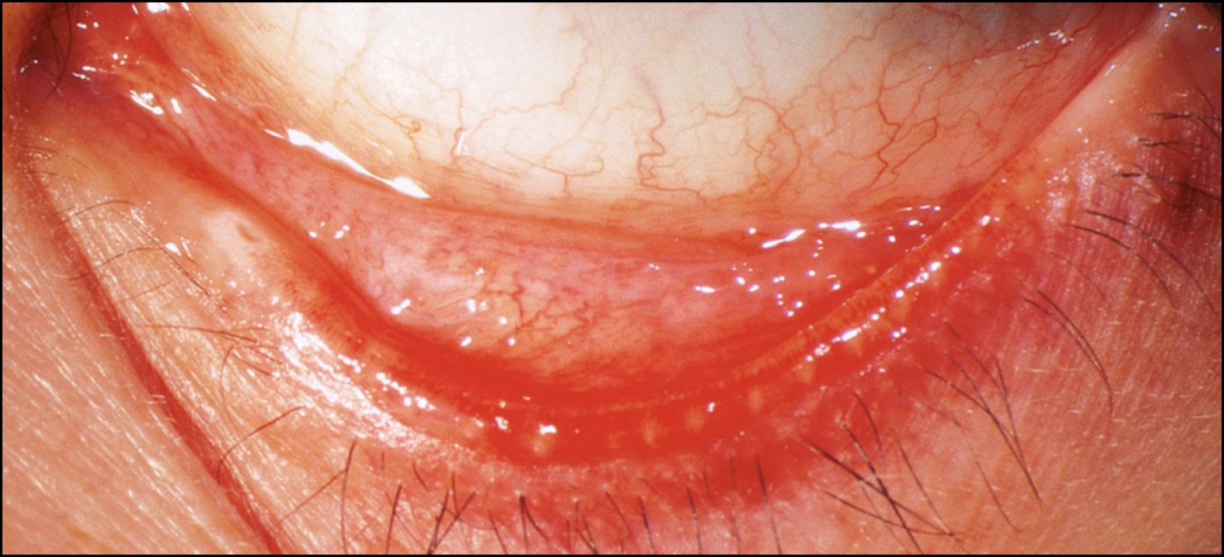Fig. 64.4, Rosacea: posterior lid inflammation.