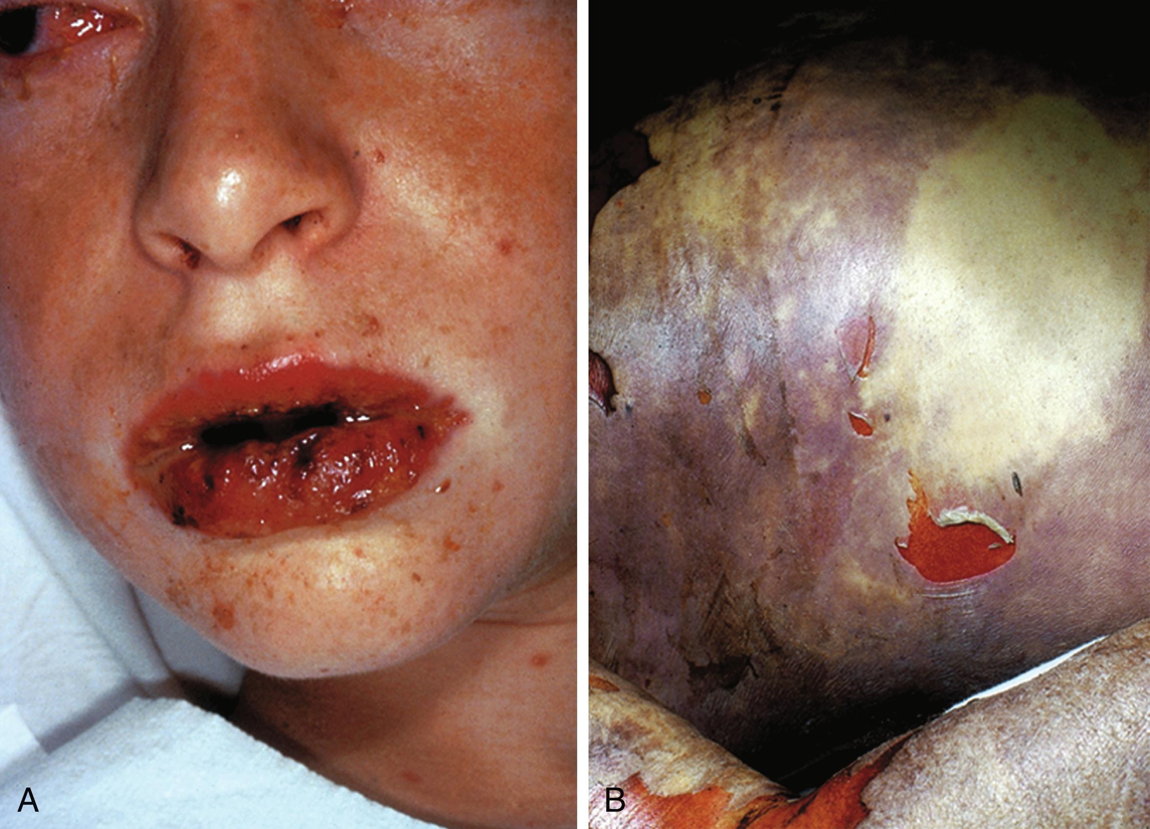 Fig. 65.1, A, Stevens-Johnson syndrome demonstrating typical mucosal inflammation of the mouth, lips, and conjunctiva. B, Fatal case of captopril-induced toxic epidermal necrolysis showing violaceous discoloration with sheets of epidermis peeling away from the skin.