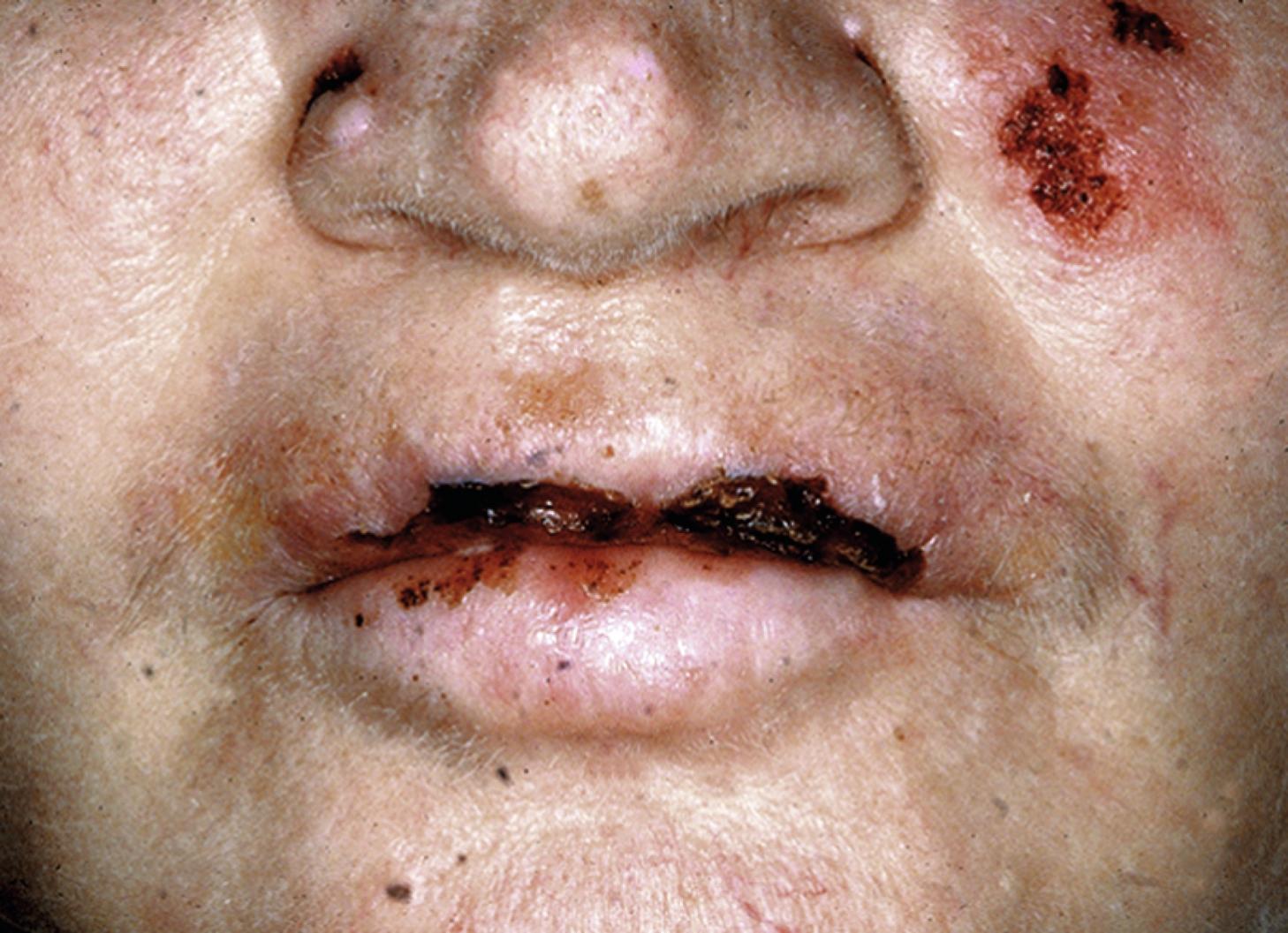 Fig. 65.2, Pemphigus vulgaris demonstrating erosive lesions of the lips and left cheek.