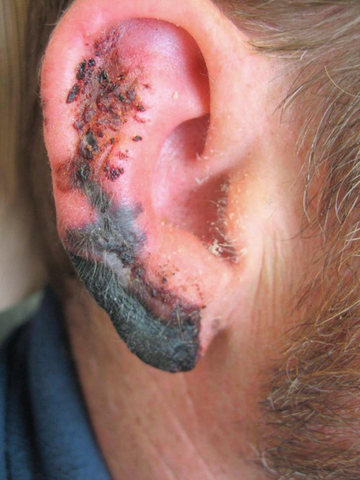 Fig. 65.3, Purpuric hemorrhagic lesions on the ear of patient using levamisole-cut cocaine.