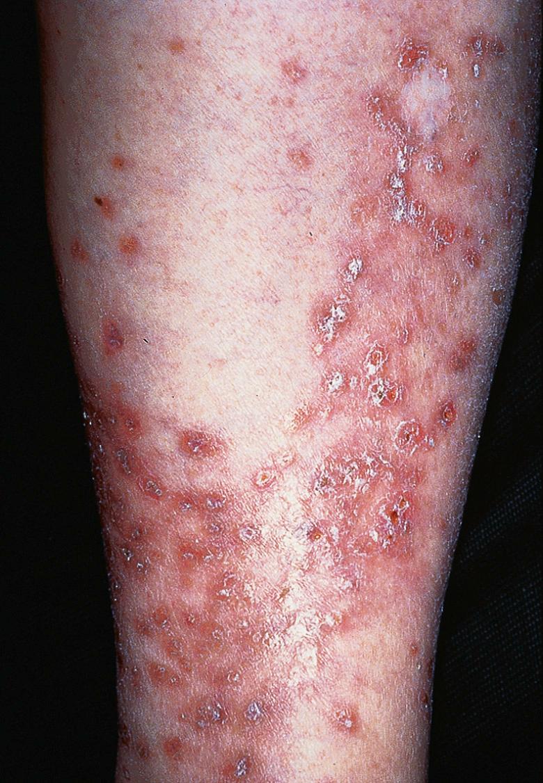 Fig. 53.1, Rheumatoid papules.