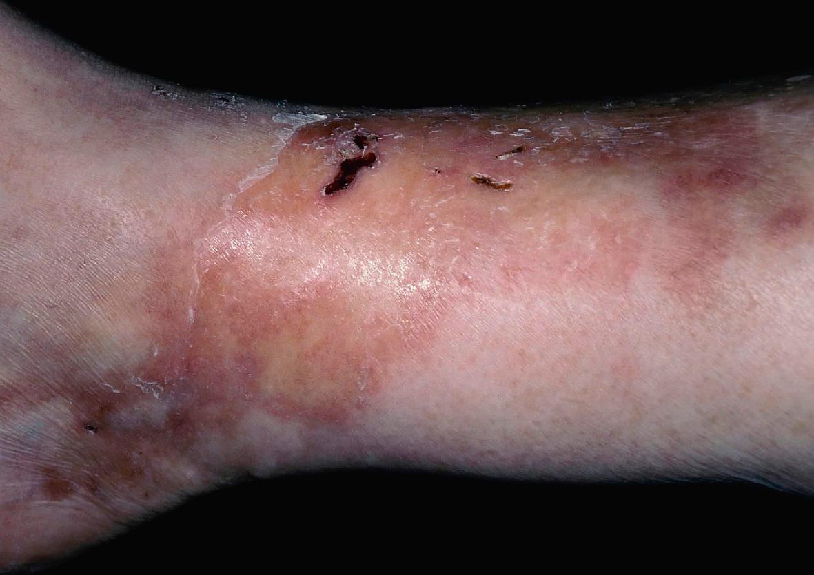 Fig. 53.3, Superficial ulcerating rheumatoid necrobiosis.