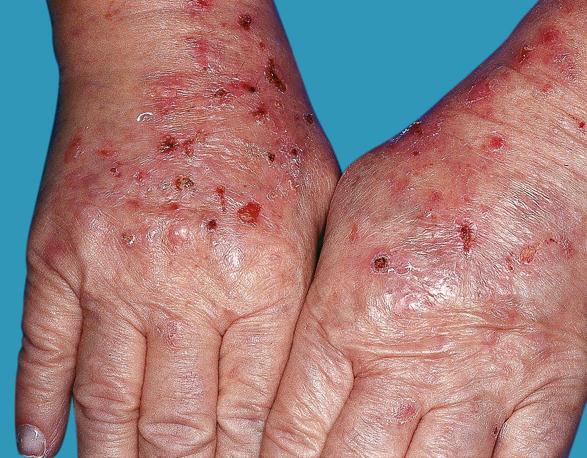 Fig. 53.5, Pseudoporphyria in a patient with rheumatoid arthritis.