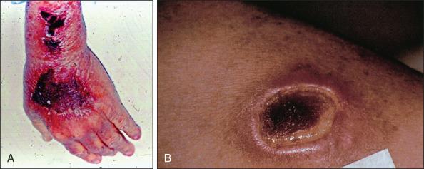 Figure 41.2, Vesicant extravasation reactions. (A–B) Late-stage lesions with a central eschar, beneath which lies an extensive area of subcutaneous necrosis.