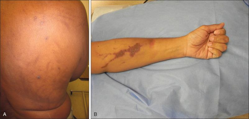 Figure 41.3, (A) Bleomycin-induced flagellate hyperpigmentation. (B) Docetaxel-induced supravenous hyperpigmentation. Erythematous, linear lesions in persons treated with bleomycin and erythematous supravenous lesions in persons treated with docetaxel often precede the appearance of increased pigmentation.