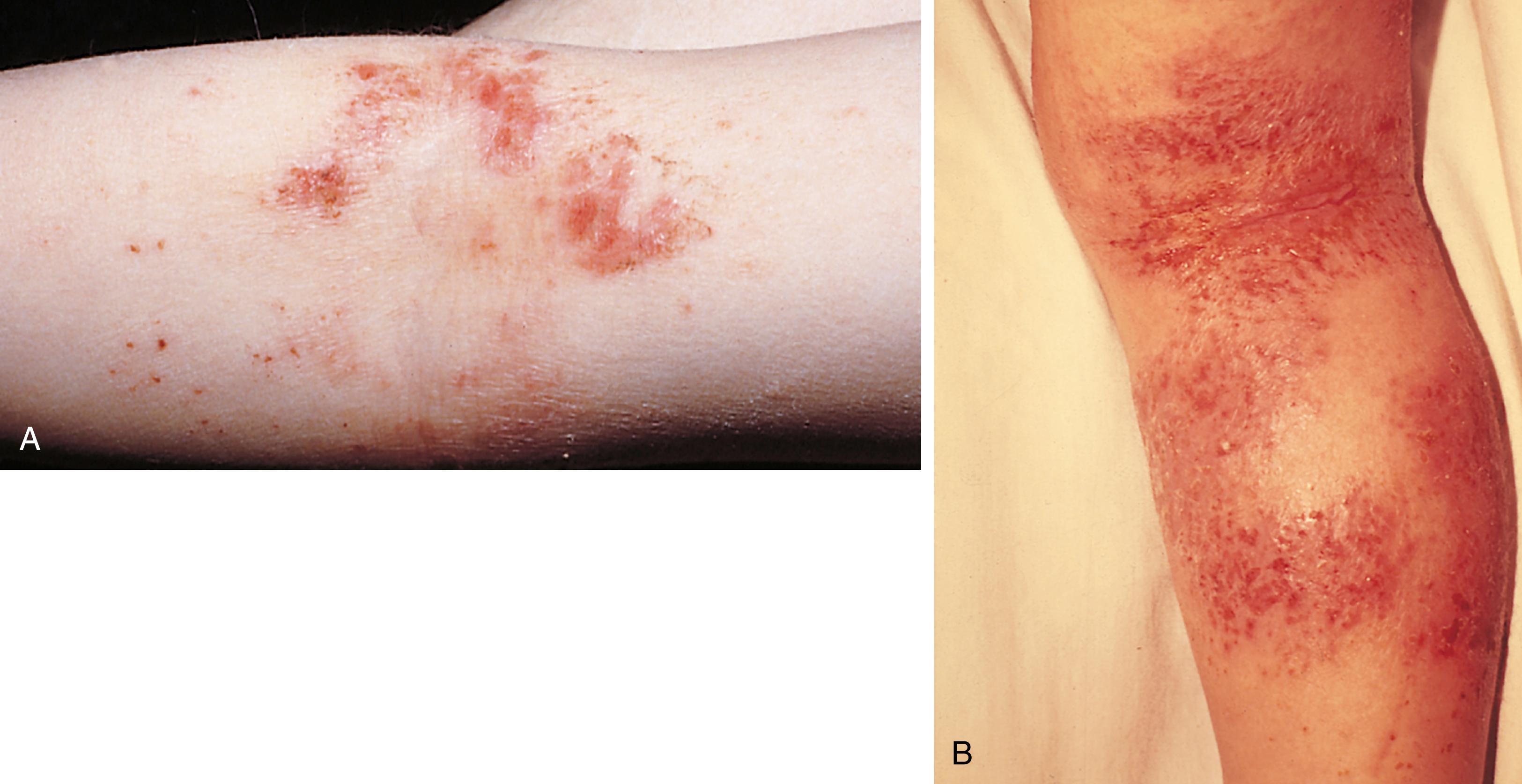 Fig. 8.12, Childhood atopic dermatitis with lesions on the arms (A) and the legs (B). In childhood, eczema involves the flexural surfaces of the upper and lower extremities. The neck, ankles, wrists, and posterior thighs also may be severely affected.