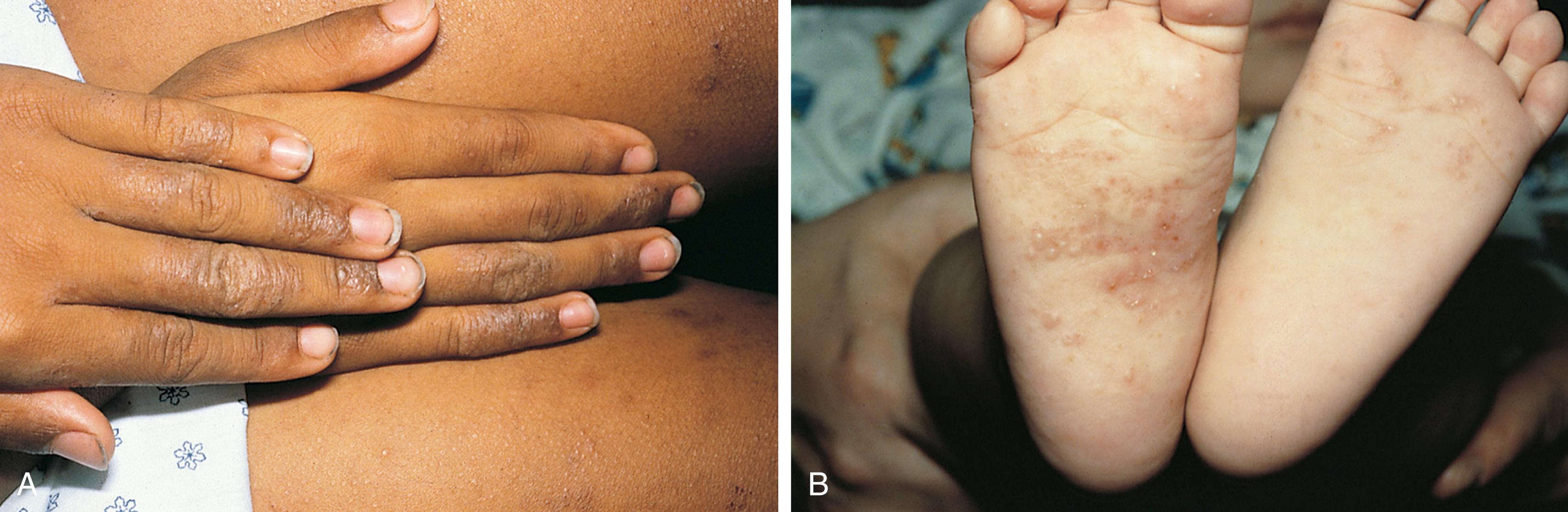 Fig. 8.13, Involvement of the hands and feet in eczema. (A) A 10-year-old atopic child has lichenification of the skin over the dorsum of his fingers and “buff” nails from chronic rubbing. (B) This infant has numerous red excoriated lesions over the soles of his feet.