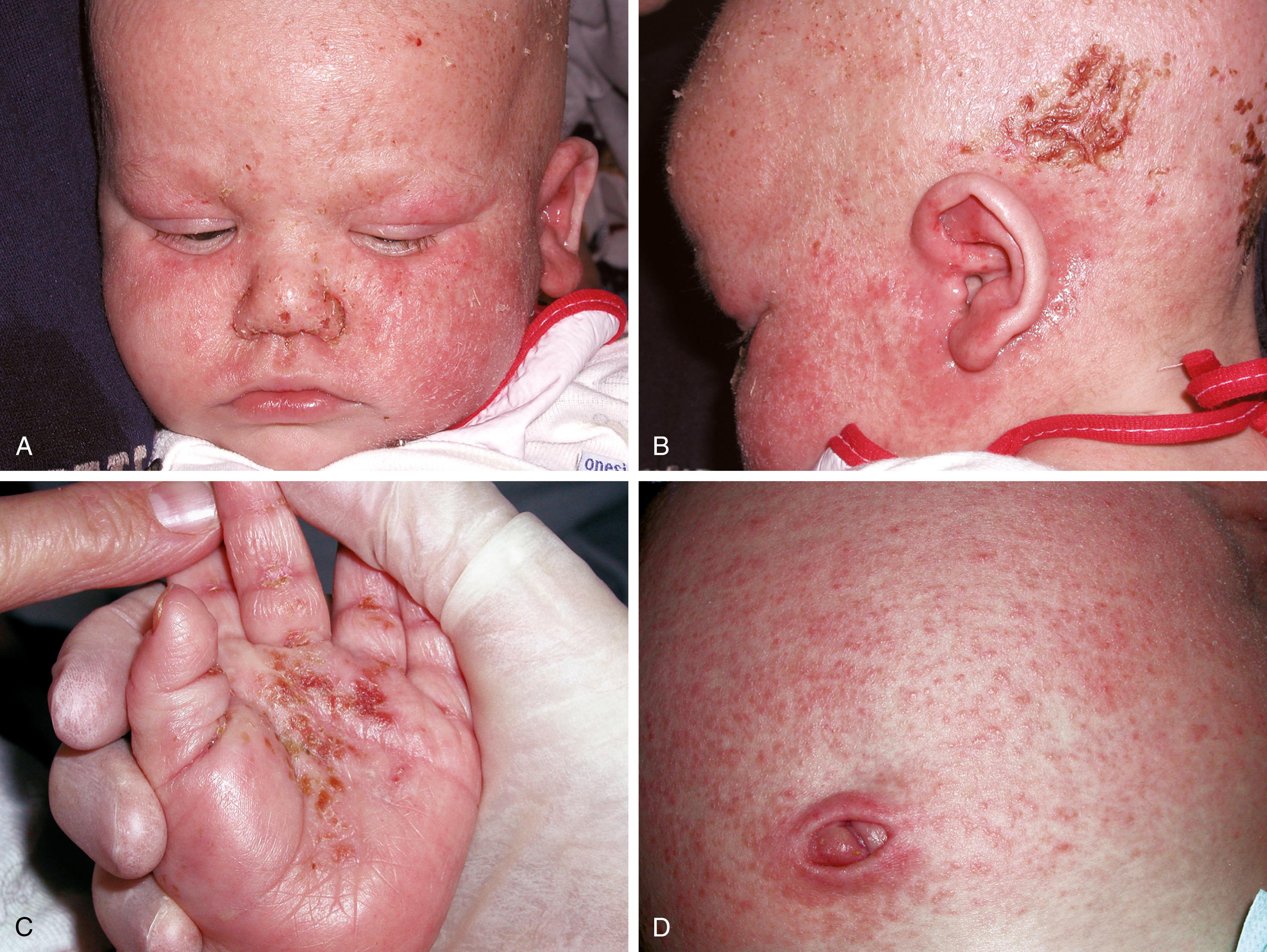 Fig. 8.25, Job syndrome. This infant with markedly elevated immunoglobulin E experienced early onset of a pruritic dermatitis that shared clinical features with both seborrhea and atopic dermatitis. (A) Note the erythema and scaliness, the evidence of excoriation from scratching, and the perinasal crusting due to Staphylococcus aureus infection. (B) In this view, in addition to the erythema, scaling, and thickening of the skin, there are weeping areas around the ear and crusts and scabs over the scalp. Note also the purulent ear drainage. (C) He also had crusted palmar lesions. (D) The skin over his abdomen had the classic features of keratosis pilaris.