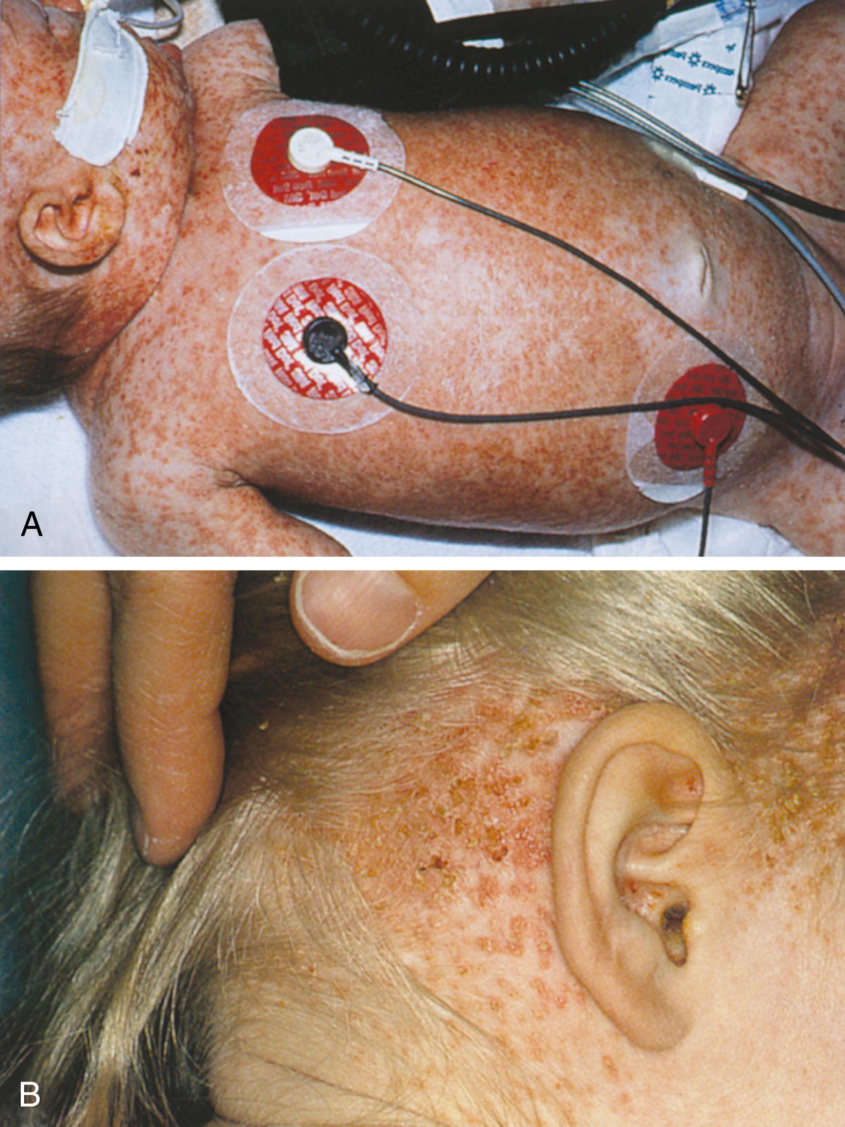 Fig. 8.88, Langerhans cell histiocytosis. (A) The exanthem in this 3-week-old infant began in the diaper area and rapidly generalized. Lesions were erythematous and scaly with interspersed petechiae. Associated findings included hepatosplenomegaly, diffuse adenopathy, and diarrhea with poor weight gain. (B) In this close-up of an older child, raised infiltrative lesions with scaly surfaces, some of which have become petechial, can be seen over the neck and scalp. Chronic draining otitis is another associated finding seen in some cases.