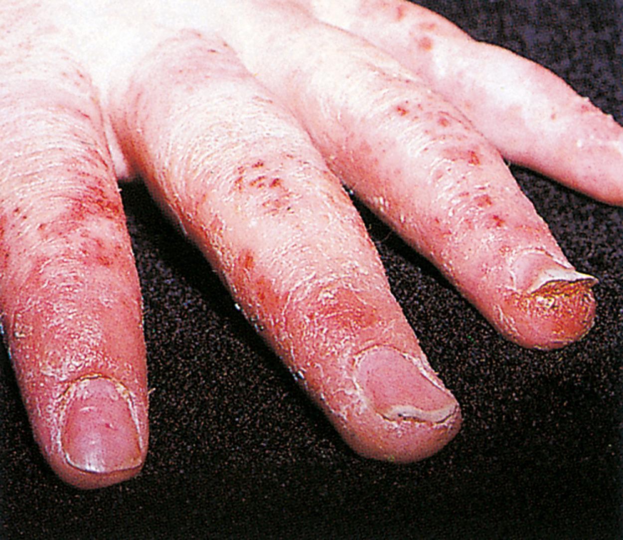 Fig. 8.18, Dyshidrosis. Chronic cracking, oozing, and scaling develop after the initial tiny pruritic vesicles have been scratched.