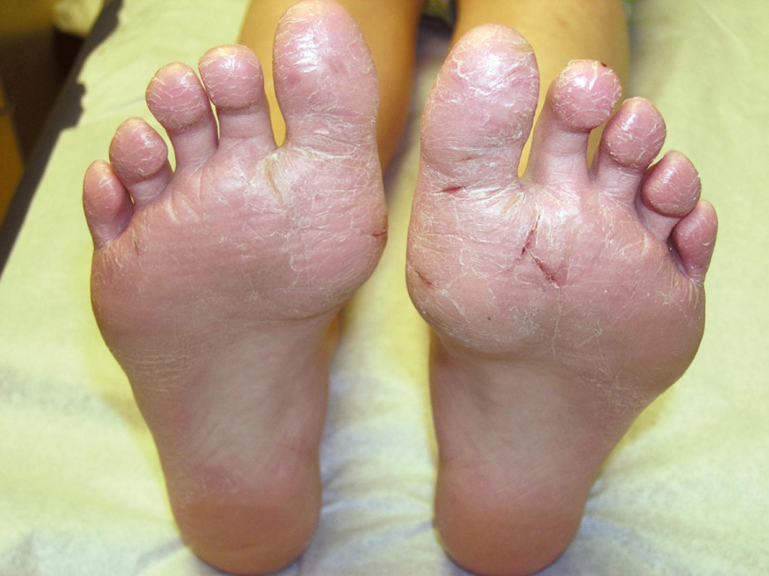 Fig. 8.20, Juvenile plantar dermatosis. This variant of atopic dermatitis is usually localized to the plantar surfaces of the toes and feet. Note the glistening erythema, scaling, and fissuring. In some patients the palms may be affected as well.