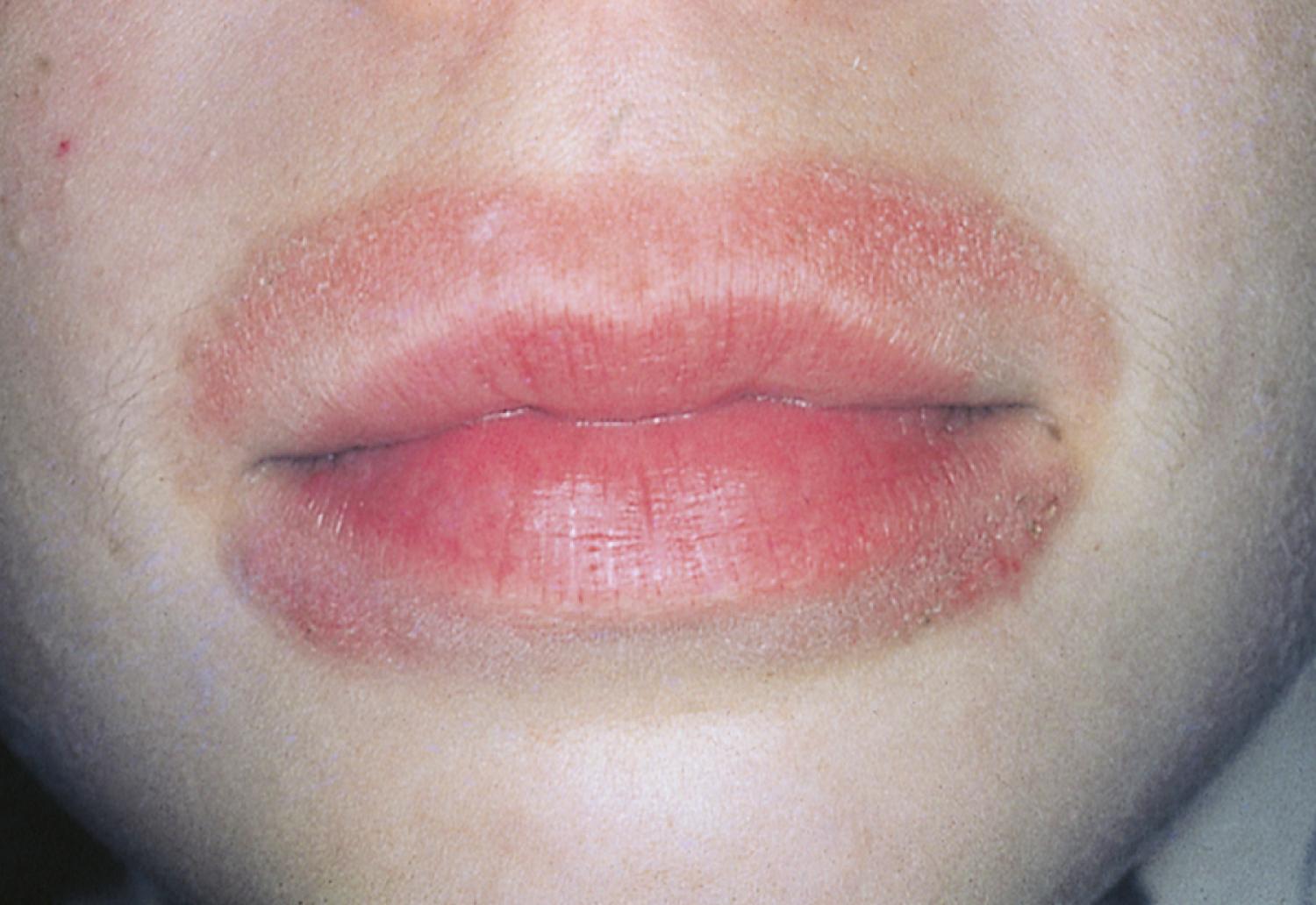 Fig. 8.21, Lip-licking eczema. The perioral skin is inflamed, scaly, and thickened as a result of repetitive licking of the lips.