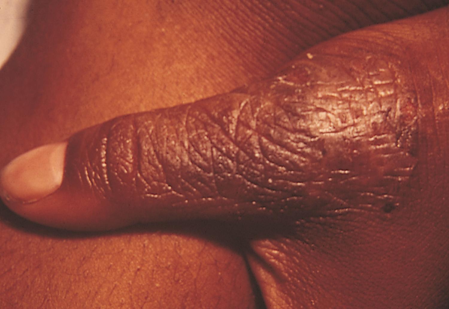 Fig. 8.22, Thumb-sucking eczema. Repeated wetting and drying from persistent thumb sucking result in eczematoid changes with cracking, fissuring, and lichenification.