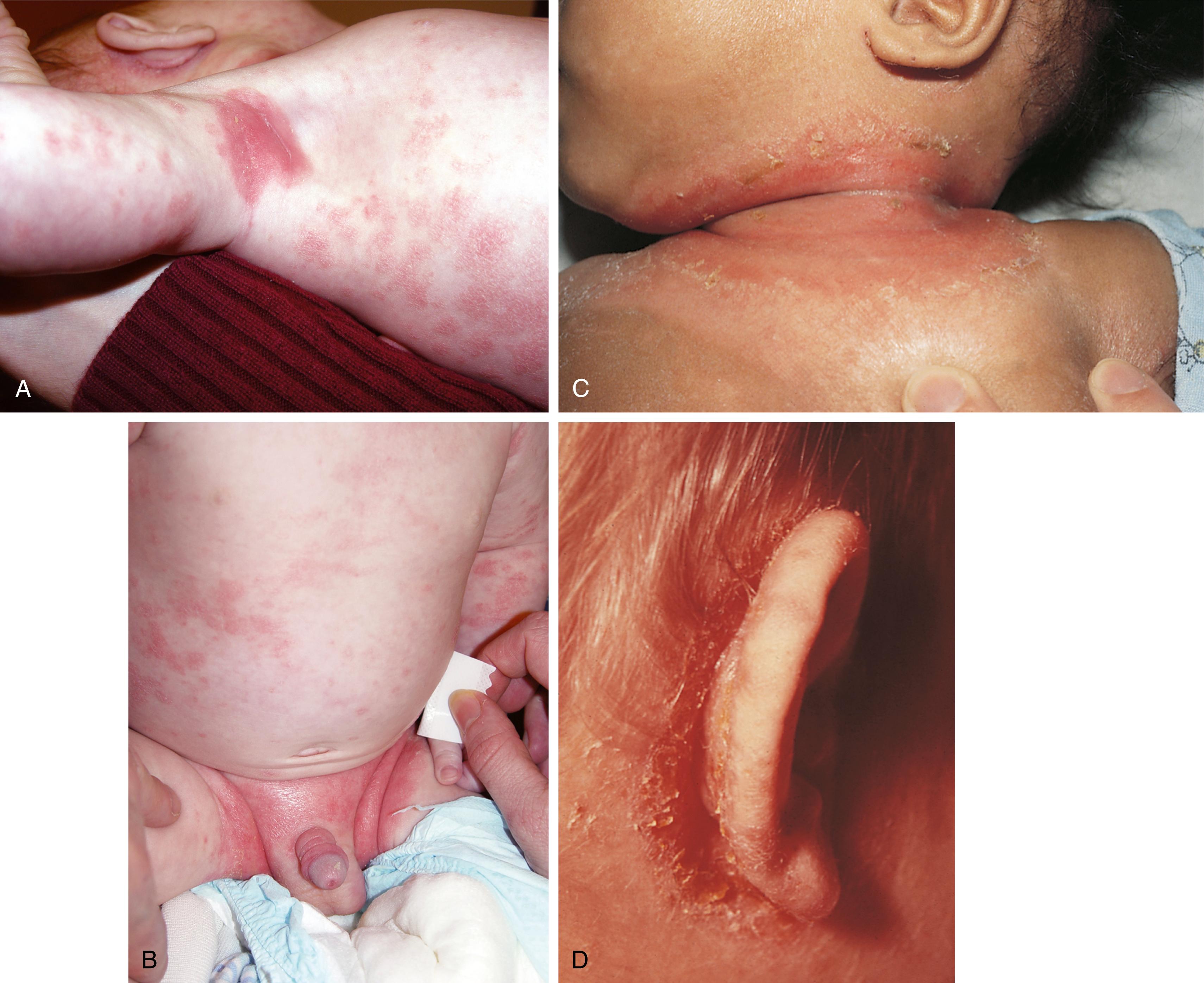 Fig. 8.23, Seborrhea. This slightly greasy, red, scaling eruption typically involves the hair-bearing areas of the face, axilla (A), and diaper area (B). (C) The intertriginous folds of the neck are another common site of involvement. (D) Postauricular lesions are common and often become secondarily infected as in this case, which grew group A β-hemolytic streptococci.