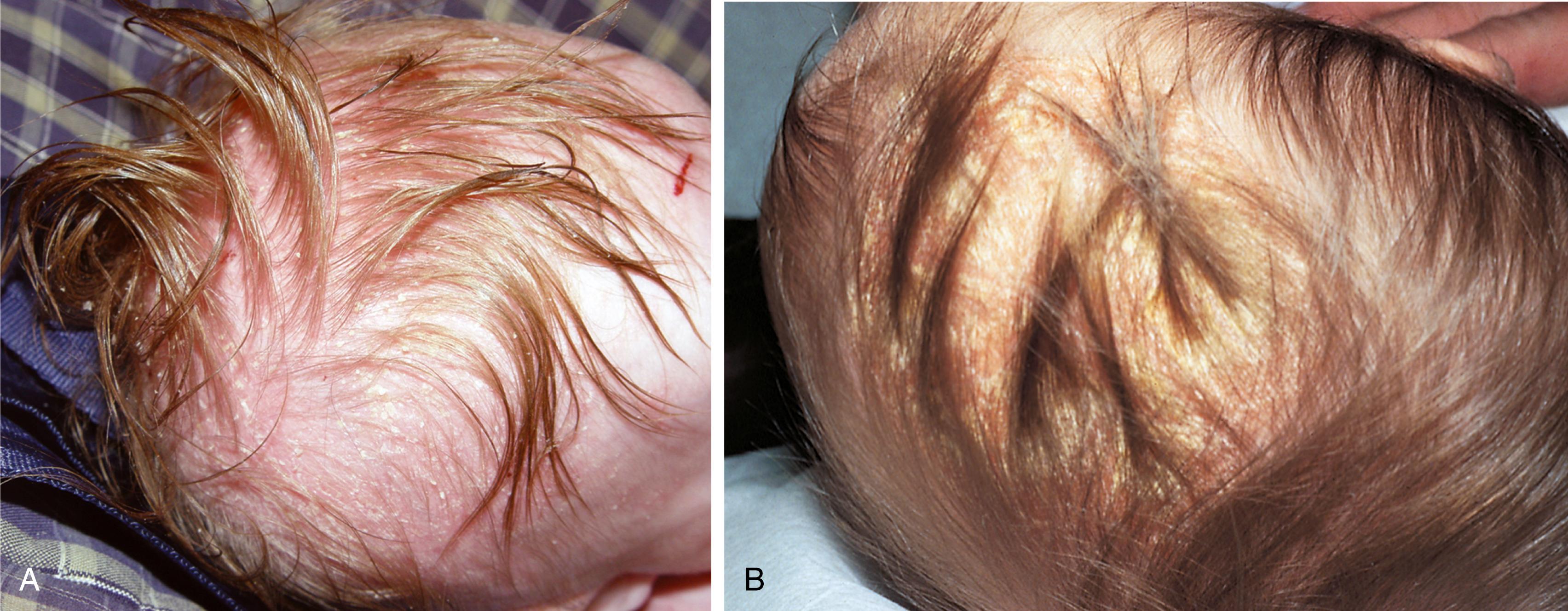 Fig. 8.24, Seborrhea of the scalp. (A) Note the oily appearance and salmon-pink hue. Numerous scales, some adherent to the scalp and many interlaced through the baby’s hair, are present. (B) In this infant the scales have formed a thick crust, and erythema is less evident.