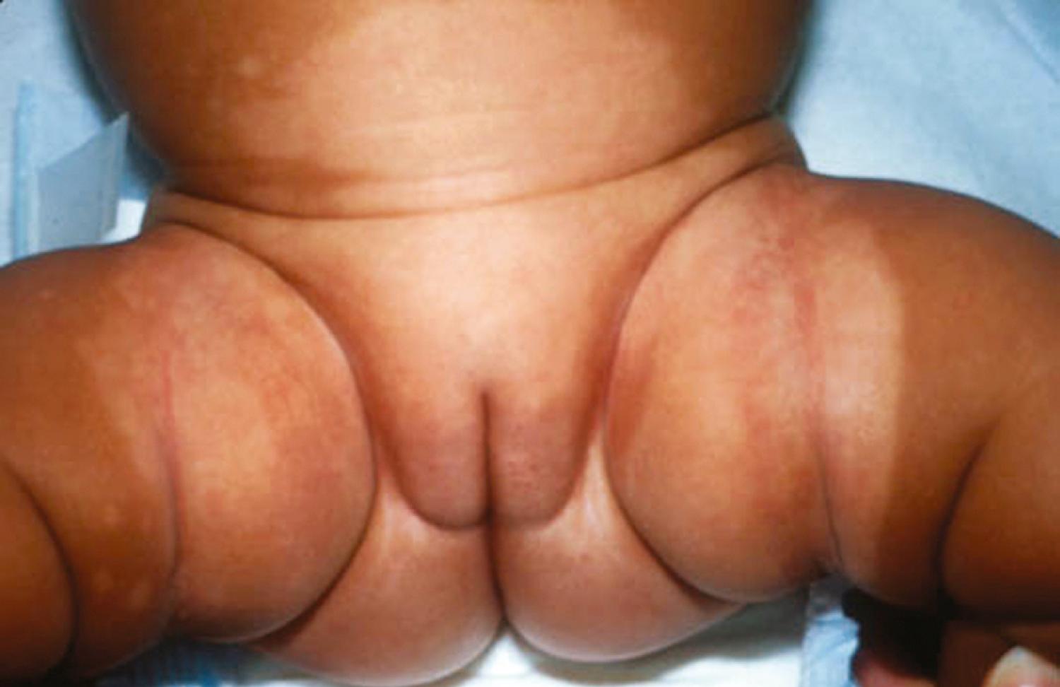 Fig. 8.117, Postinflammatory hypopigmentation is evident in this infant after treatment with topical agents for seborrheic diaper dermatitis.