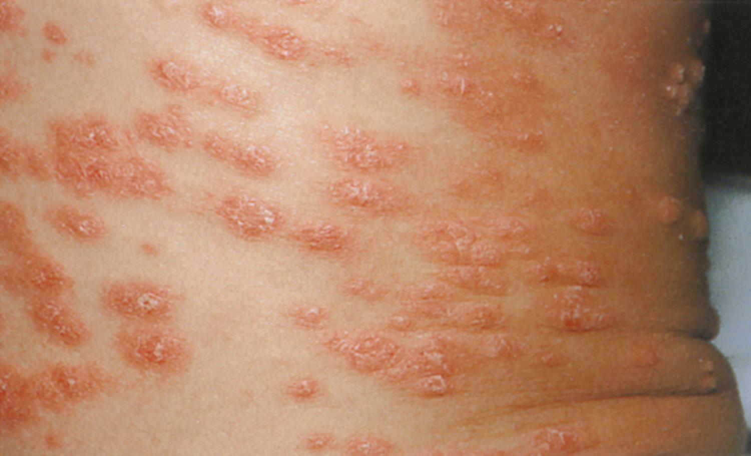 Fig. 8.4, Guttate psoriasis. Small drop-like plaques with typical scales quickly developed in a generalized distribution in this child following streptococcal pharyngitis.