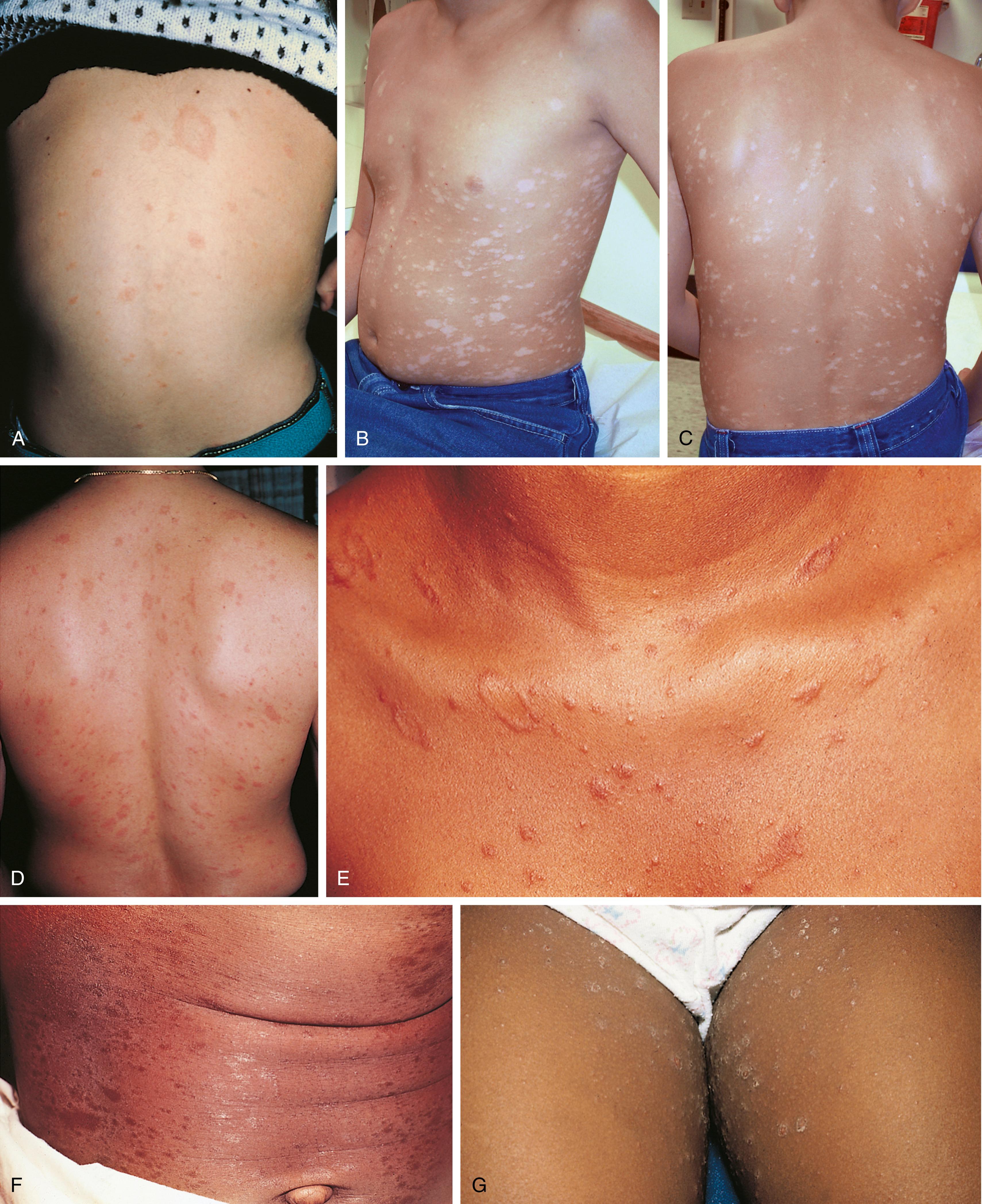 Fig. 8.26, Pityriasis rosea. (A) The large herald patch on this boy’s back shows evidence of central clearing, mimicking tinea corporis. (B) Numerous oval lesions with their long axes oriented along lines of skin cleavage are seen over the trunk of this adolescent. (C and D) This feature creates the appearance of a fir tree distribution on the back. (E–G) Lesions can be raised, macular, or scaly and can be erythematous or hyperpigmented or hypopigmented.