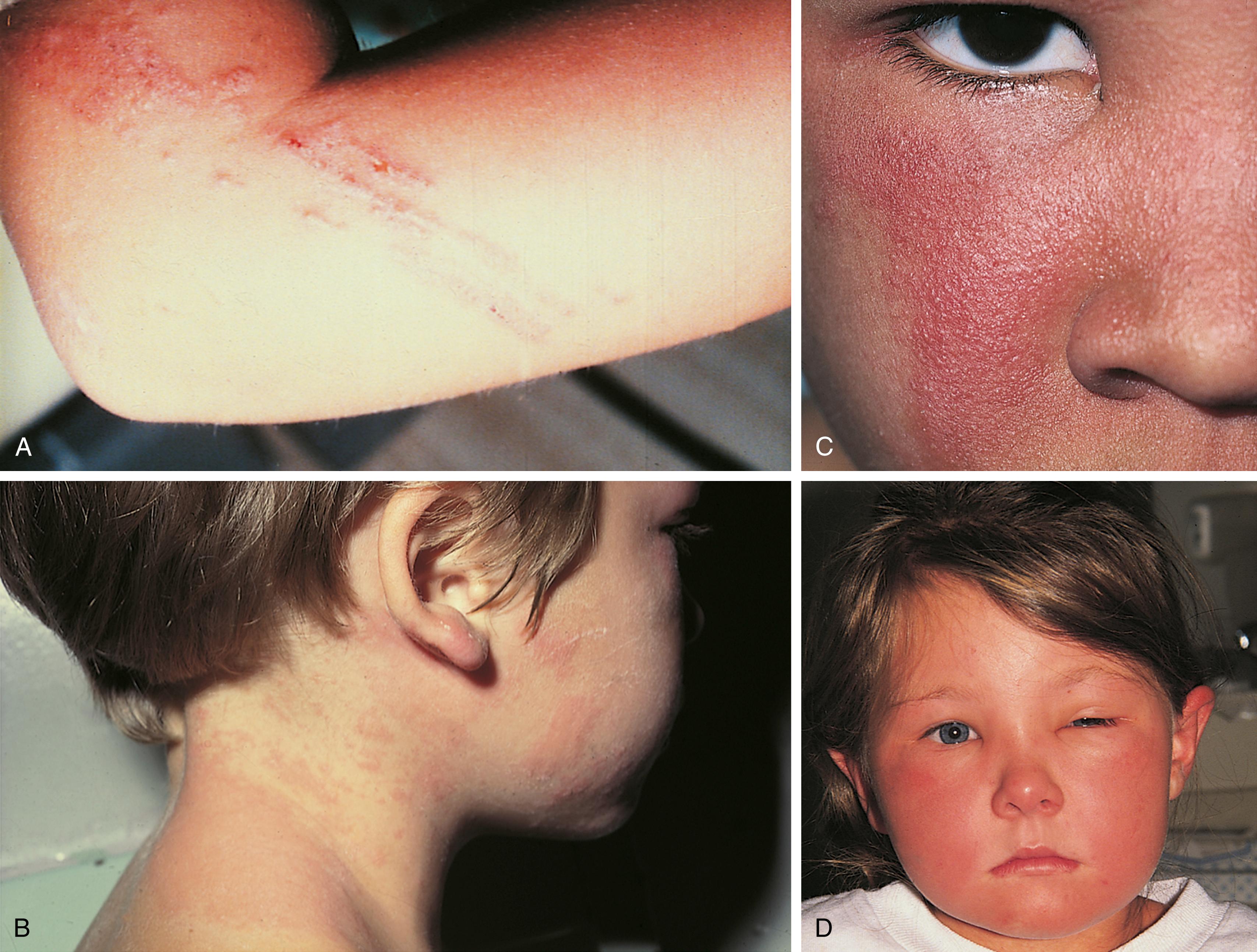 Fig. 8.28, Poison ivy, or rhus dermatitis. (A) Linear streaks of pruritic vesicles are typical of contact dermatitis caused by exposure to a plant. (B and C) However, with heavier exposure, the eruption can develop in relatively large patches. Also note the microvesicular appearance of the facial lesion in the child shown in C. (D) Reactions involving the face and genitalia can provoke impressive swelling.