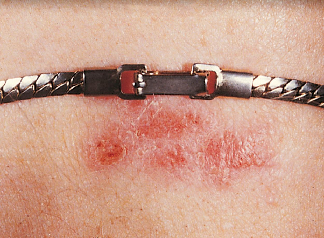 Fig. 8.30, Nickel contact dermatitis. The location and distribution of the rash are often helpful in determining the cause of a contact dermatitis. In this case, wrist lesions were triggered by the nickel in her bracelet clasp.