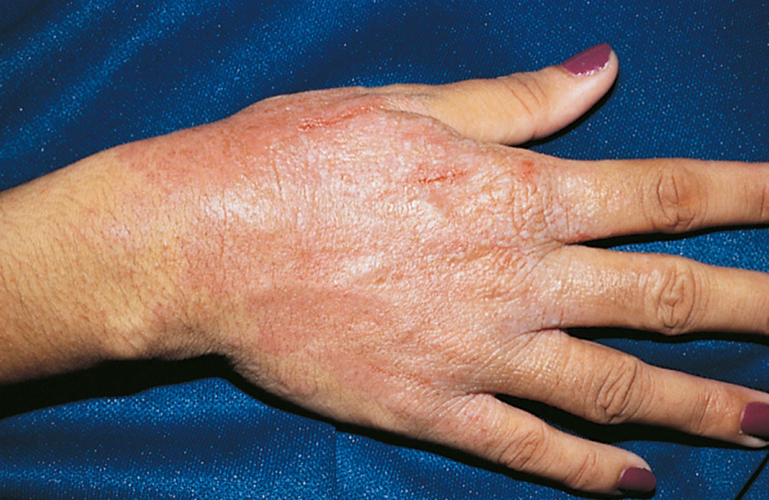Fig. 8.33, Contact dermatitis due to topical anesthetics. This adolescent became sensitized to the topical anesthetic benzocaine (Lanacane) in a moisturizing cream that she applied to her hands daily. Note the line of demarcation at the wrist.