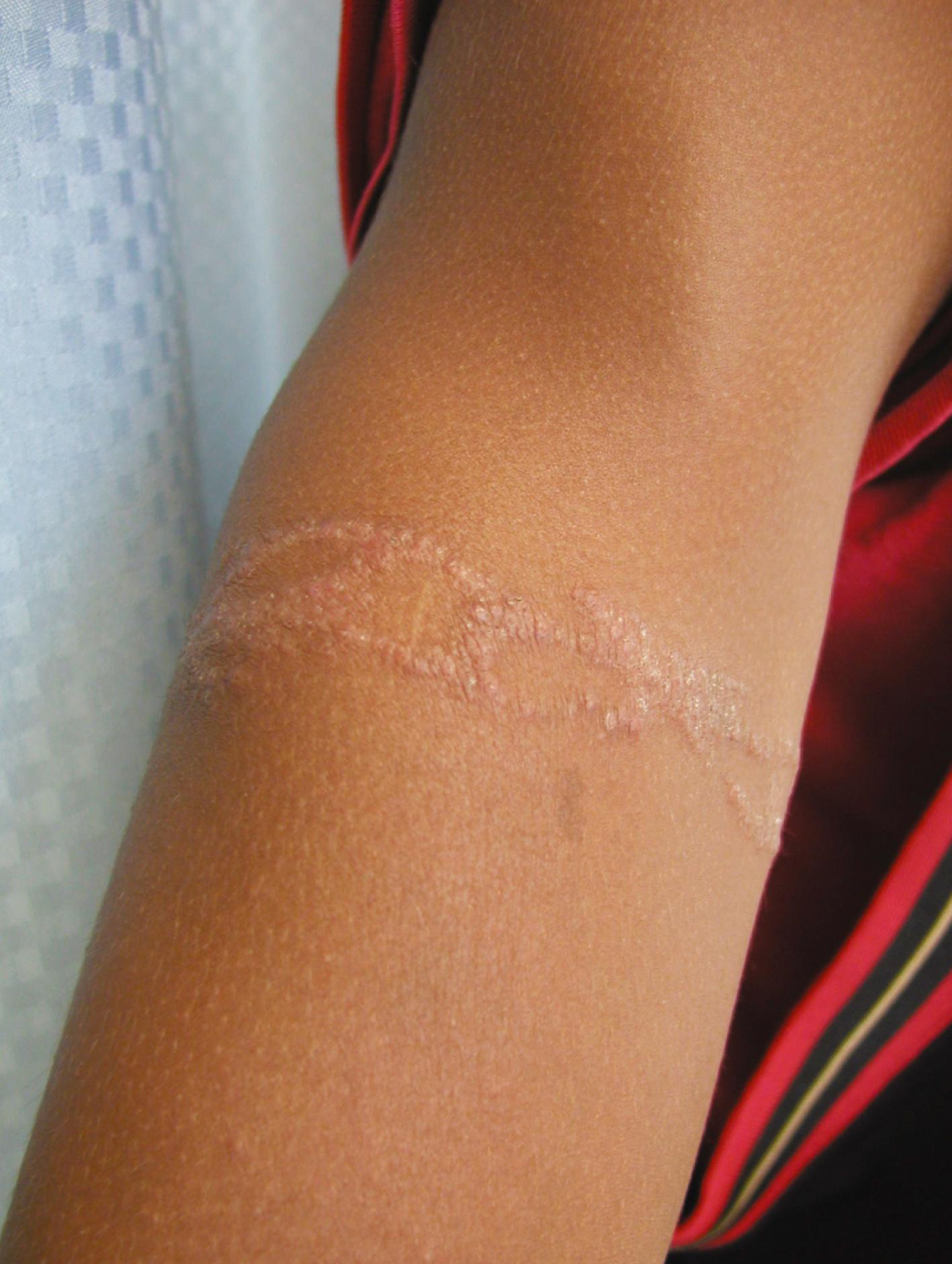 Fig. 8.34, Contact dermatitis due to henna dye. This young teenager developed vesicular lesions in the precise pattern of a henna tattoo she had had applied 2 weeks earlier.