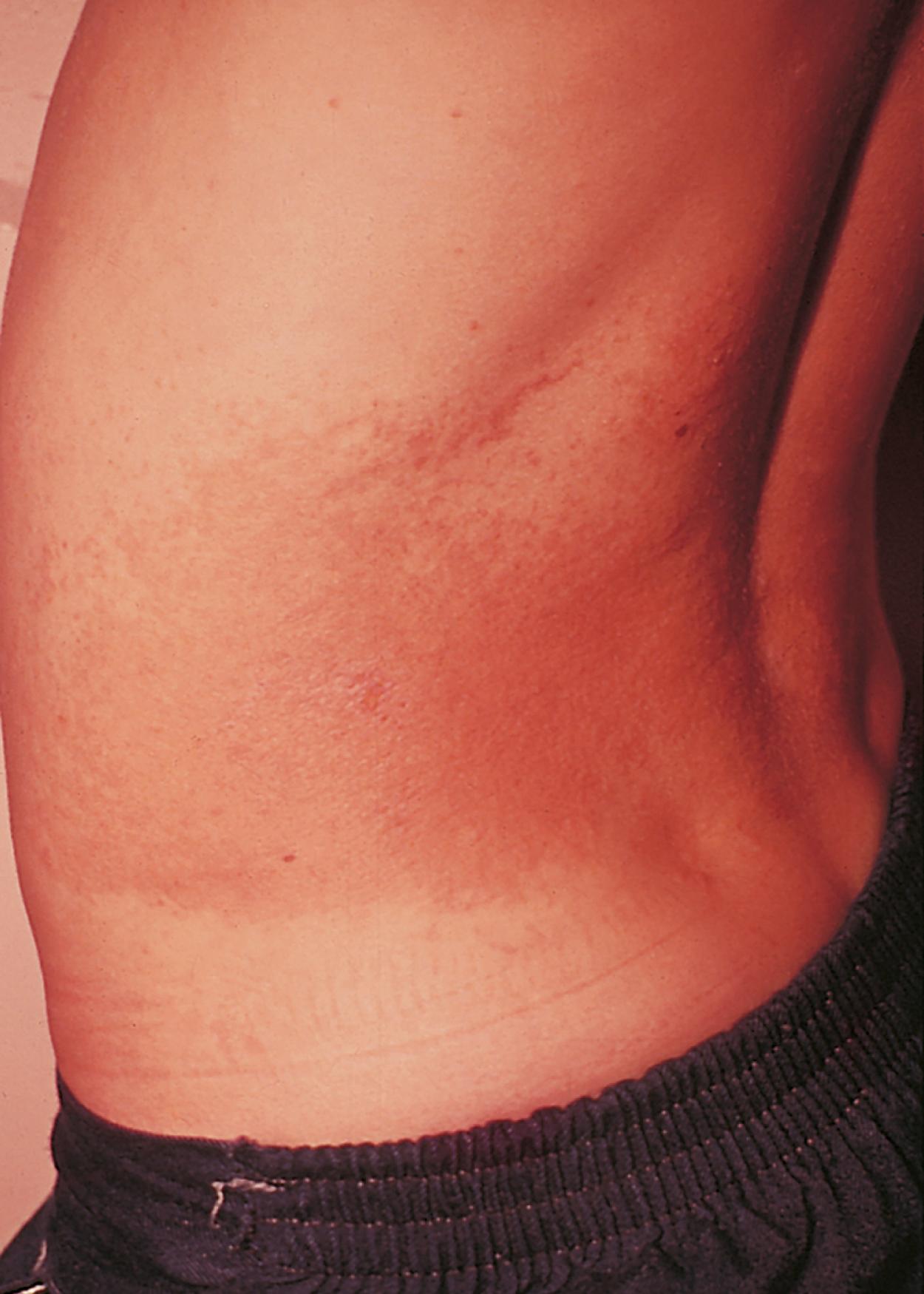 Fig. 8.35, Photocontact dermatitis. This boy developed contact dermatitis after sun exposure while outside for a day of swimming. The offending agent was found to be in his soap.